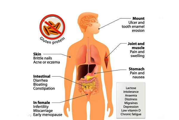 Celiac Disease