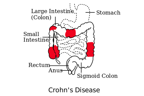 Crohns Disease