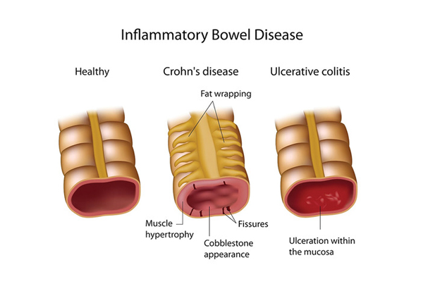 IBD