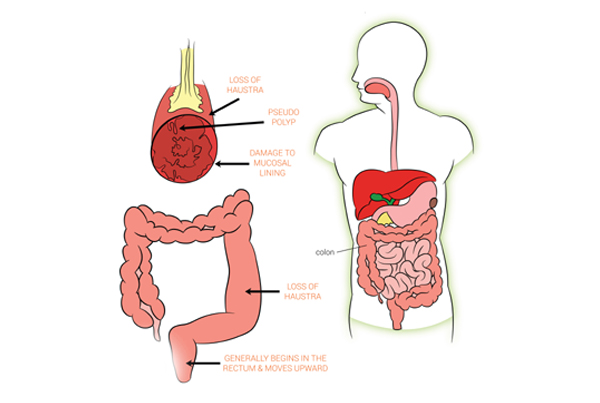 Ulcerative Colitis