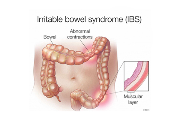 IBS