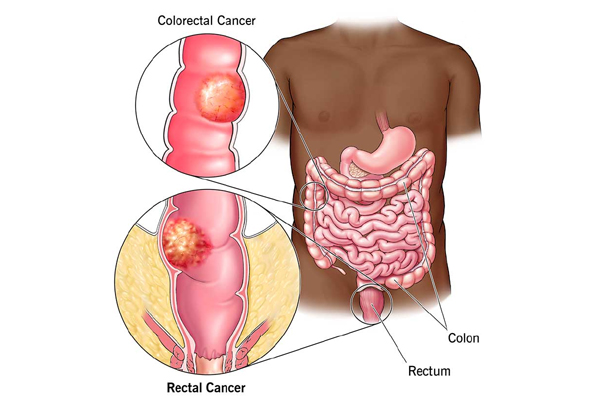 Colon Cancer