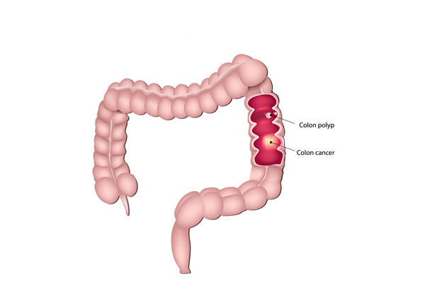 Colon Polyps