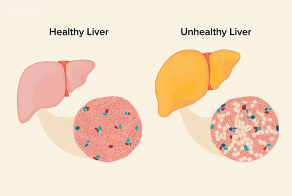 Fatty Liver