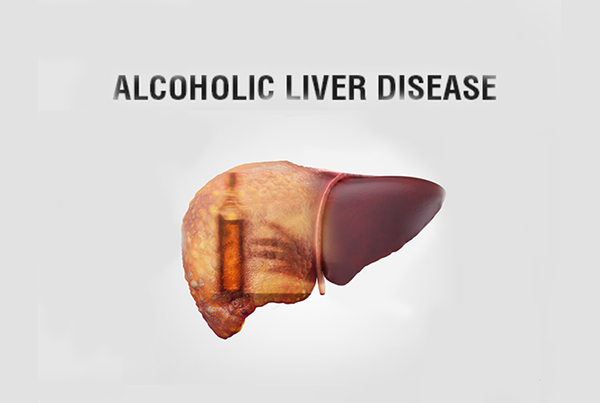 Alcoholic Liver Disease