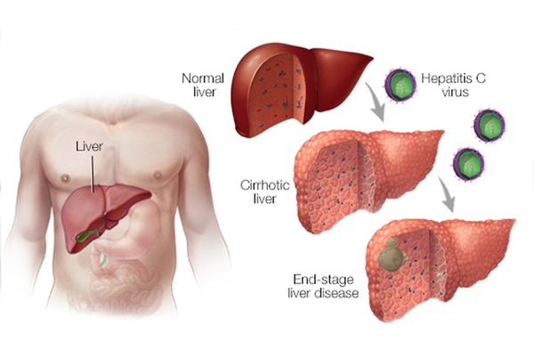 Viral Hepatitis