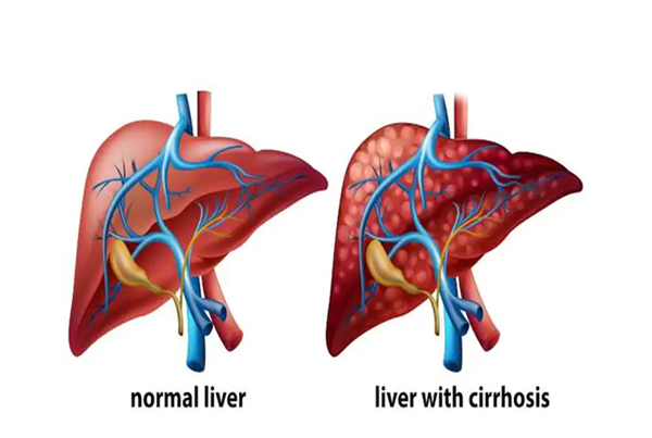 Liver Cirrhosis