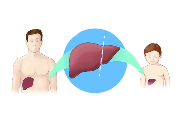 Liver Transplant