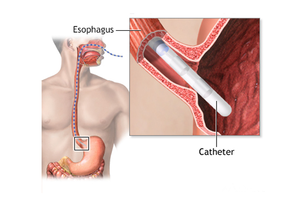 Esophageal Motility Disorders