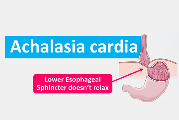 Achalasia Cardia