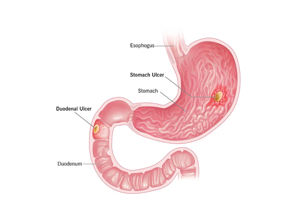 Gastric Ulcer