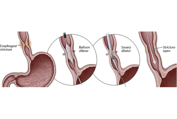 Esophageal Strictures