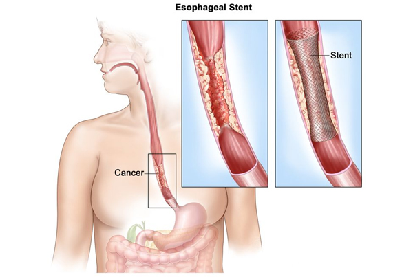 Esophageal Cancer