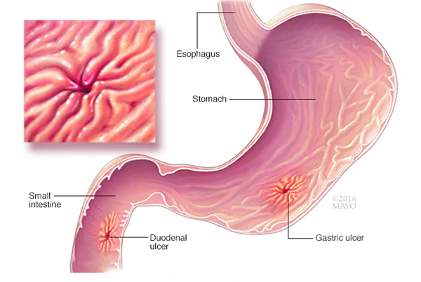 H Pylori Infection