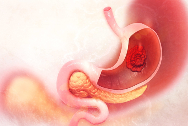 Gastric Cancer