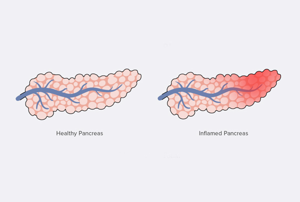 Acute and Chronic Pancreatitis