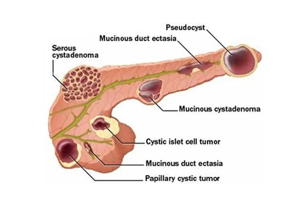 Pancreatic Pseudocyst