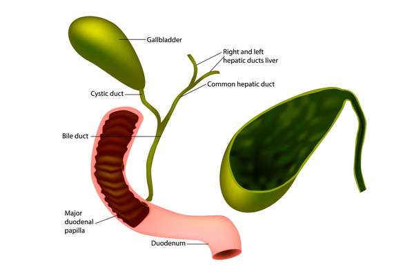 Bile Duct Stone