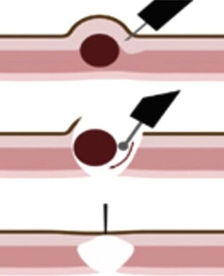 Endoscopic full thickness resection (EFTR) for gastrointestinal tumors performed by advanced endoscopy specialist in Delhi