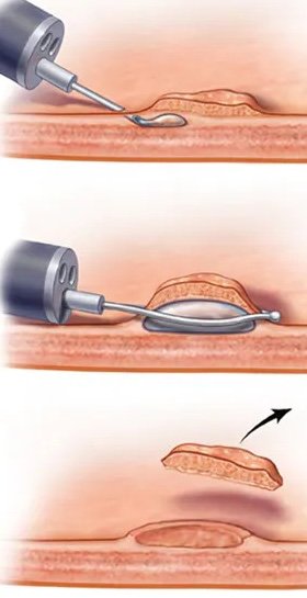Endoscopic mucosal resection (EMR) for early GI cancer removal without surgery by gastroenterologist in Delhi
