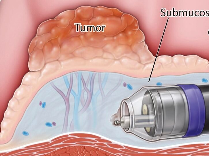 Endoscopic submucosal dissection (ESD) for early gastrointestinal cancer treatment by expert endoscopist in Delhi