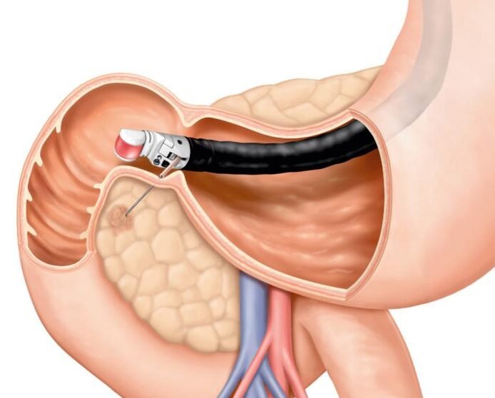 Endoscopic ultrasound (EUS) procedure performed by experienced gastroenterologist in Delhi for pancreas and bile duct evaluation