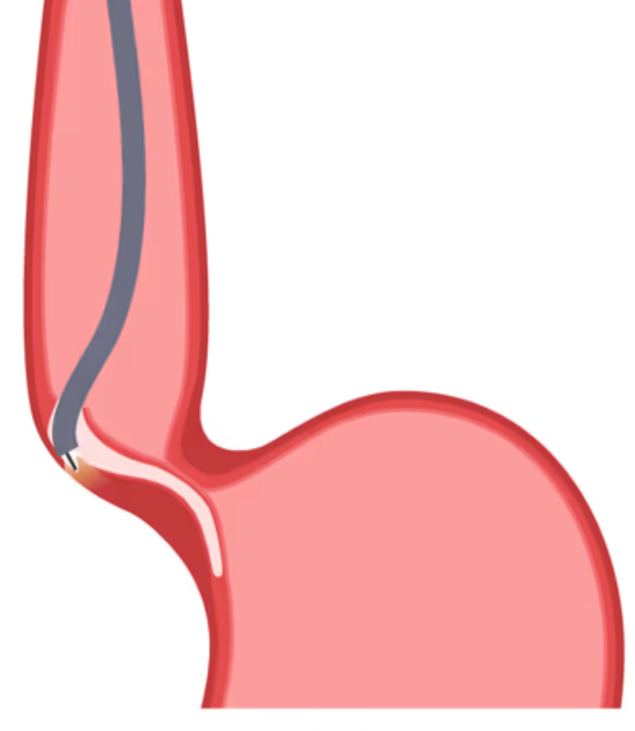 poem achalasia treatment delhi dr surakshith endoscopy